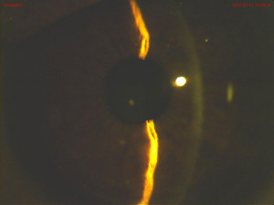 Figure 4. Deepened anterior chamber depth OD one day after instillation of tropicamide.