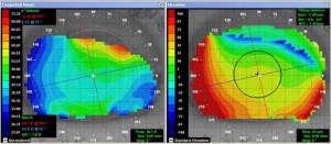 Figure 3. Corneal topography OD showing curvature change superiorly