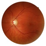 Figure 1B. During routine examination, C/D ratio in the left eye was noted to be .65/.65. Click to enlarge
