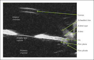 Figure 4. Ultrasound biomicroscopy (UBM) of a normal eye. This is a typical cross-sectional, in vivo image that can be obtained using UBM. The anatomic relationships between the structures can be evaluated easily. Click to enlarge