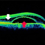 Figure 3. OCT showing retinoschisis (white arrow) and neurosensory retinal detachment (red arrow) OD. Click to enlarge
