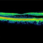 Figure 5A. Decreased size and amplitude of retinoschisis and neurosensory retinal detachment OD after eight months of treatment for glaucoma. Click to enlarge