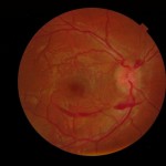 Figure 1A. Initial optometric examination revealed a pre-retinal hemorrhage OD. Click to enlarge