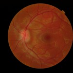 Figure 1B. Initial optometric examination revealed papilledema OU. Click to enlarge