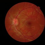 Figure 3B. Dilated fundus photography at the six-month follow-up visit at the eye clinic showed significant reduction of bilateral disc edema. Click to enlarge