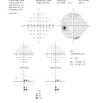 Figure 3B. SITA Standard 24-2 Humphrey Visual Field test results OS from the patient’s final visit in November 2011. Note the improvement in the central scotoma compared with initial testing as seen in both the threshold and pattern deviations.Click to enlarge