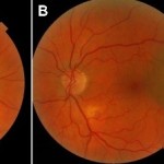 Figure 1. Fundus photographs at initial presentation, A: right eye, B: left eye. Click to enlarge