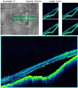 figur 6. Högupplöst spektraldomän OCT genom koroidalt melanom OS avslöjar neurosensorisk avskiljning med subretinal vätska. Klicka för att förstora