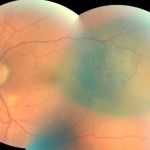 Figure 7. Fundus photography OS two months after brachytherapy (artifact at inferior-temporal vascular arcade). Click to enlarge