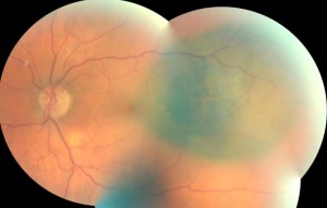 Figure 7. Fundus photography OS two months after brachytherapy (artifact at inferior-temporal vascular arcade). Click to enlarge