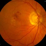 Figure 4. Fundus photograph OD on 06/28/16 showing a mottled appearance of the right macula with several small and intermediate drusen as well as a subretinal hemorrhage slightly superior to the macula. Click to enlarge 