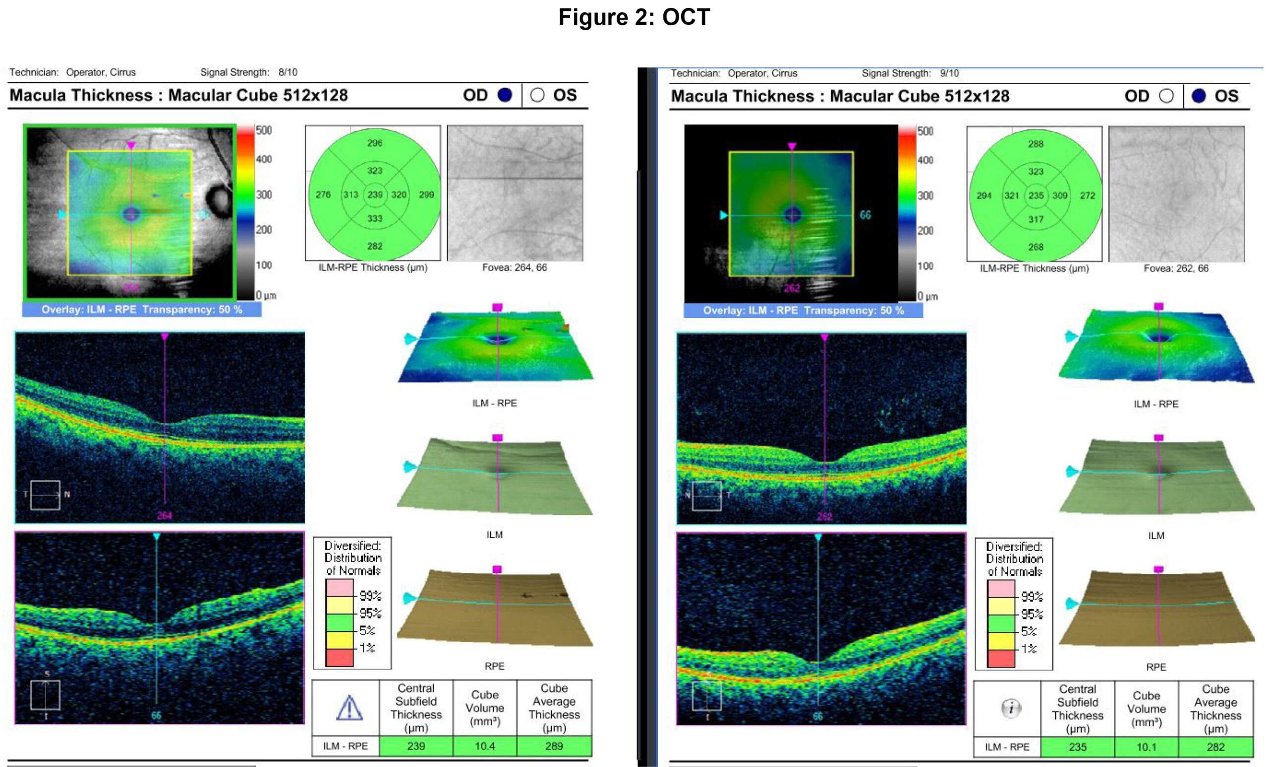Hyperopic Shift Following Rapid Glycemic Control in a Diabetic Adult: A ...